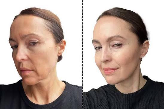 Full Face & Jawline Transformation