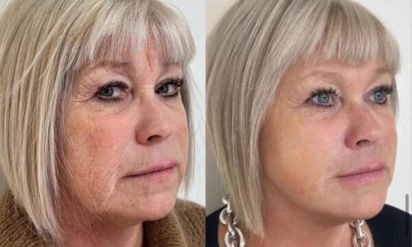 Neck & Jowl Tightening